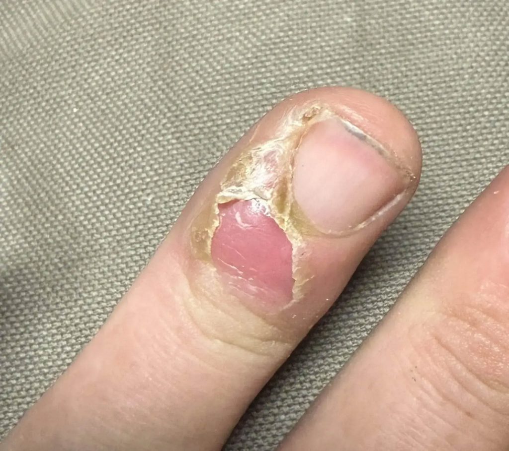 Damaged Thumbnail Nail With Exposed Nail Bed During Healing Damaged Thumbnail Nail With Exposed Nail Bed During Healing